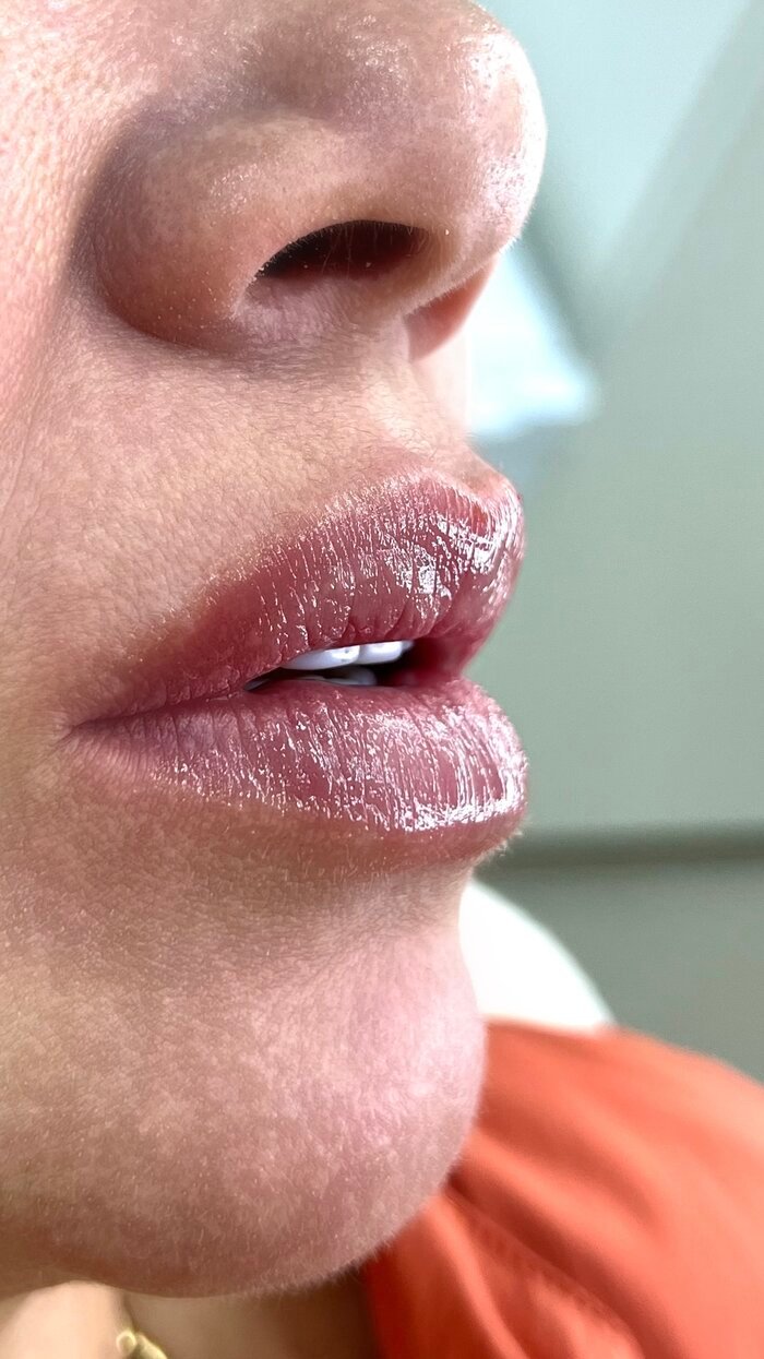 Resultado de harmonização orofacial