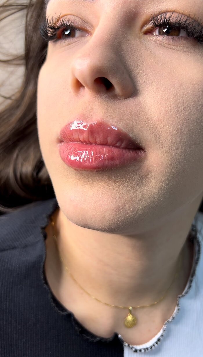 Resultado de harmonização orofacial
